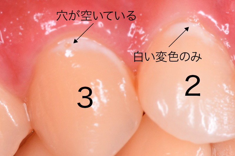う蝕写真1