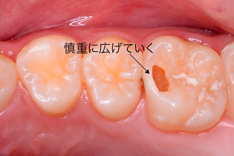 う蝕写真4